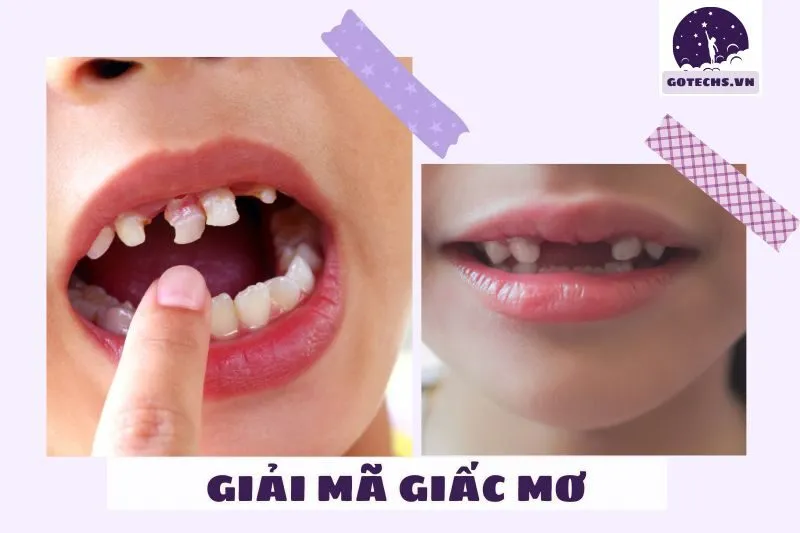 Ý Nghĩa Tâm Lý Học Khi Nằm Mơ Thấy Rụng Răng